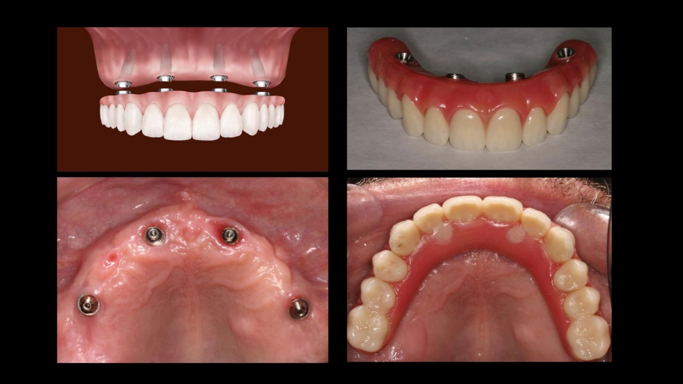 All On 4 Dental Implants In Hewlett Hewlett All On 4 Dental Implants all-on-4-dental-implants-in-hewlett-hewlett-all-on-4-dental-implants